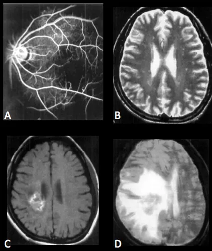Images médicales montrant des anomalies des artères rétiniennes et des lésions cérébrales.