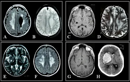 “Imagerie cérébrale montrant diverses conditions médicales liées à la mutation COL4A1 chez quatre membres d’une même fratrie.
