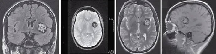 Images IRM montrant un cavernome volumineux dans le cerveau d’un patient