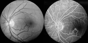Images comparatives de la rétine, montrant une communication artério-veineuse du groupe 2, plus visible en angiographie à la fluorescéine.