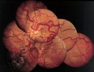 Image d’une rétine avec un réseau vasculaire désorganisé, illustrant le groupe iii de désorganisation.