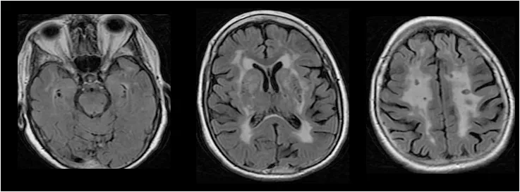 Figure 3 Illustration des anomalies observées en IRM dans la substance blanche d’une personne atteinte de CADASIL. Certaines zones, plus claires, renvoient un signal anormal.