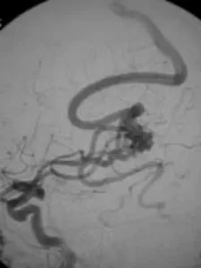 Une artériographie carotide montrant la malformation artérioveineuse alimentée par des branches de l’artère cérébrale moyenne.