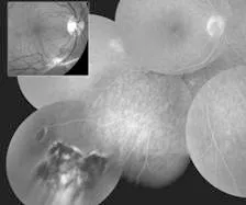 Une image montrant la rétine d’un œil avant et après un traitement au laser pour une maladie appelée mtp.