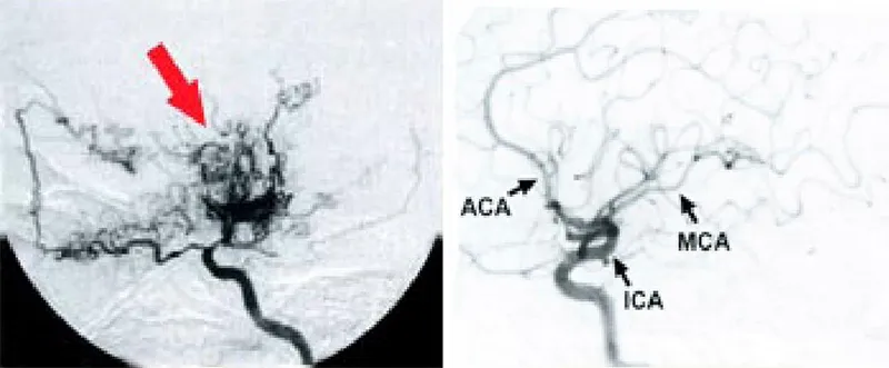 Figure 2: A gauche, angiographie d'une personne atteinte de la maladie de Moya Moya. De petits vaisseaux en "volute de fumée" apparaissent pour pallier le rétrécissement de l'artère carotide interne ou de ses branches (artères cérébrales antérieure ou moyenne). A droite, angiographie montrant des artères normales. MCA: artère cérébrale moyenne ACA: artère cérébrale antérieure ICA: artère carotide interne