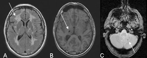 Figure 2: Illustration des anomalies IRM rencontrées sur les séquences FLAIR (A), T1 (B) et écho de gradient (C)