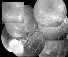 Une image montrant la rétine d’un œil avant et après un traitement au laser pour une maladie appelée mtp.