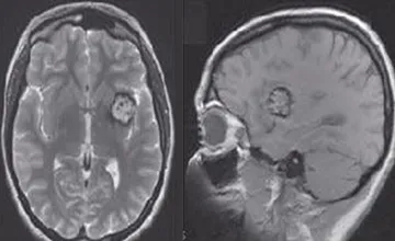 Images IRM montrant la Cavernomatose Cérébrale Familiale