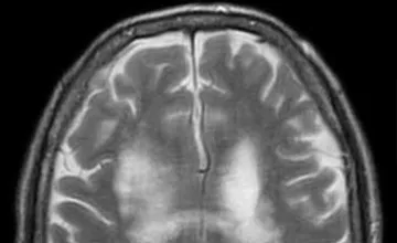 Image d’une IRM montrant une leucoencéphalopathie avec kyste et calcifications
