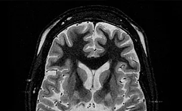 Image d’une IRM cérébrale montrant des signes de Leucoencéphalopathies Vasculaires Autosomiques Dominantes