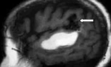 Image d’une IRM cérébrale montrant une malformation artério-veineuse.