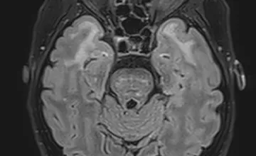 Scans IRM du cerveau montrant des signes de CADASIL, une maladie vasculaire cérébrale rare.