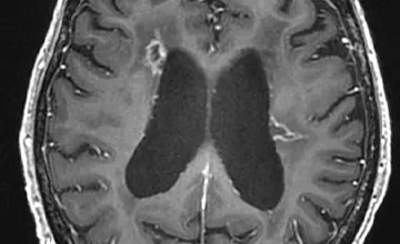 Image A montrant une angiographie rétinienne et Image B montrant une IRM cérébrale, illustrant l’Angiopathie Cérébro-Rétinienne Liée Au Gène TREX.