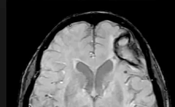 Image IRM du cerveau montrant des signes d’angiopathie amyloïde cérébrale familiale