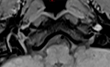 Image d’une IRM montrant une dissection des artères cervicales et cérébrales.