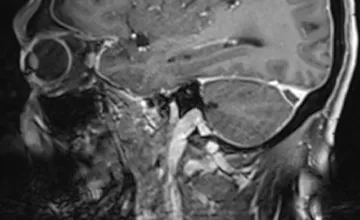 Image IRM montrant une thrombose veineuse cérébrale, une maladie rare.