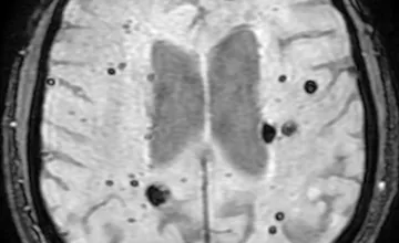 Image d’une IRM cérébrale montrant des cavernomes rétiniens et cérébraux.